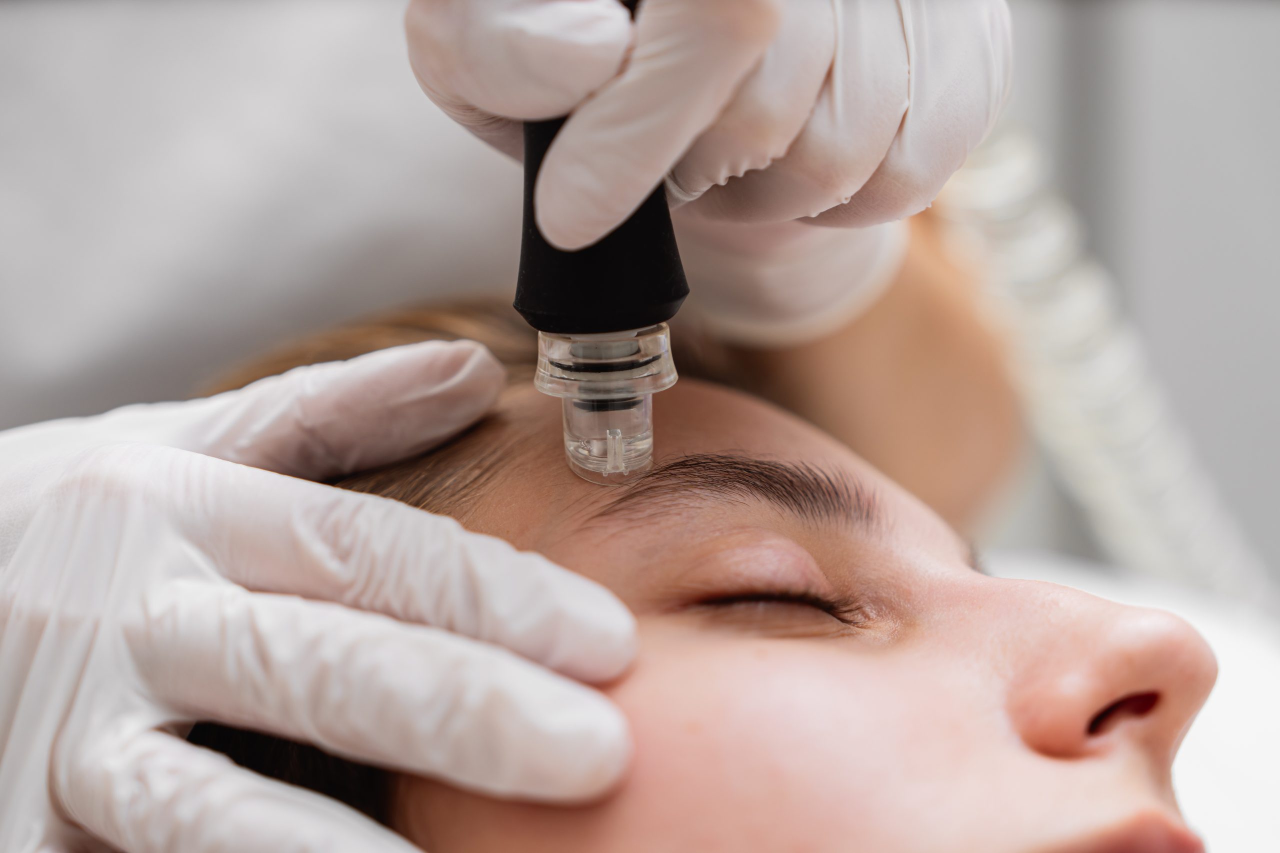 traitement microdermabrasion