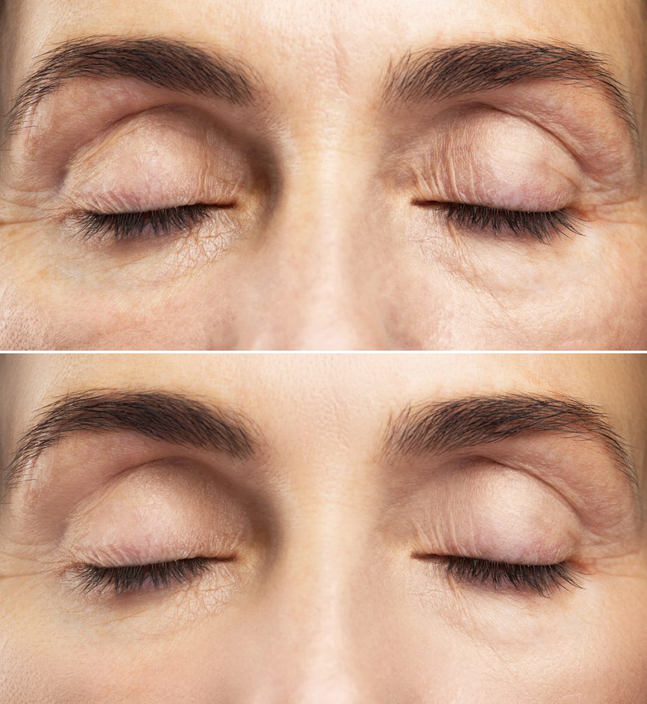 Remodelage Structurel Du Visage - RMD pour un lifting contour des yeux