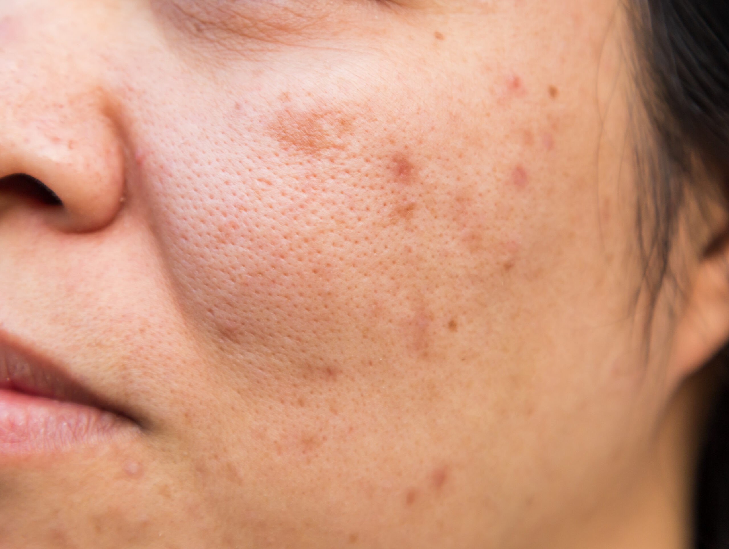 facial peau grasse mont-tremblant
